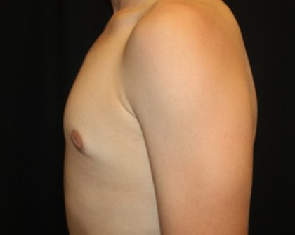 Gynecomastia Before & After Patient #21261