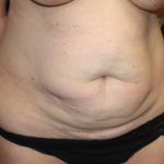 Tummy Tuck Before & After Patient #19952