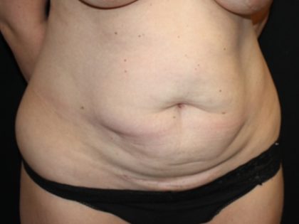 Tummy Tuck Before & After Patient #19952
