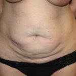 Tummy Tuck Before & After Patient #19952