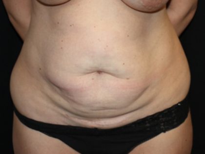 Tummy Tuck Before & After Patient #19952