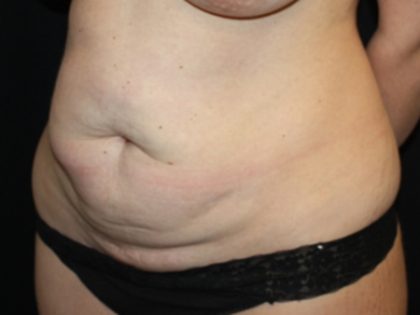 Tummy Tuck Before & After Patient #19952