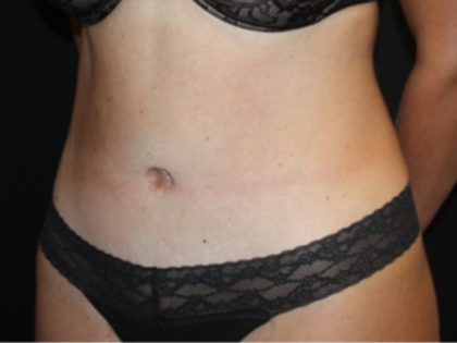 Tummy Tuck Before & After Patient #19952