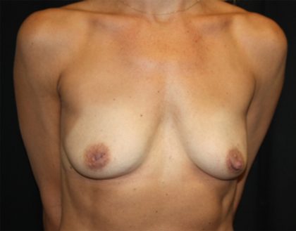 Breast Lift with Implant Before & After Patient #20785