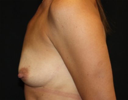 Breast Lift with Implant Before & After Patient #20785