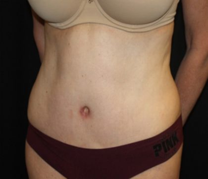 Tummy Tuck Before & After Patient #22981