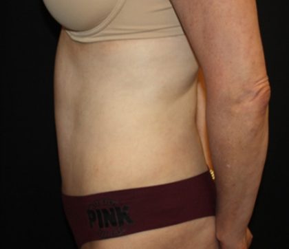 Tummy Tuck Before & After Patient #22981