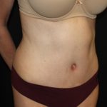 Tummy Tuck Before & After Patient #22981