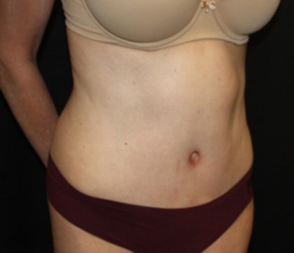 Tummy Tuck Before & After Patient #22981