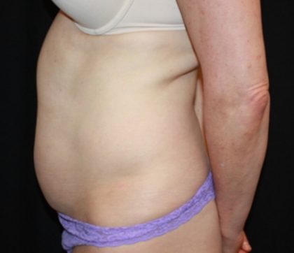 Tummy Tuck Before & After Patient #22981