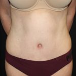 Tummy Tuck Before & After Patient #22981