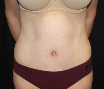 Tummy Tuck Before & After Patient #22981