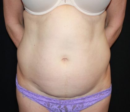 Tummy Tuck Before & After Patient #22981