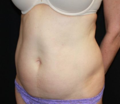 Tummy Tuck Before & After Patient #22981