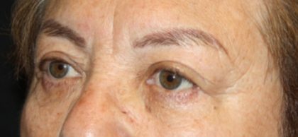 Brow Lift Before & After Patient #21115