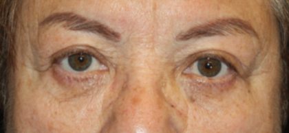 Brow Lift Before & After Patient #21115