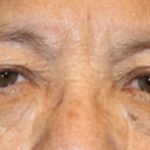 Brow Lift Before & After Patient #21115