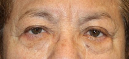 Brow Lift Before & After Patient #21115