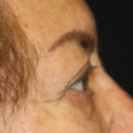 Brow Lift Before & After Patient #21115