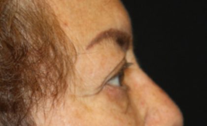 Brow Lift Before & After Patient #21115