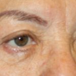 Brow Lift Before & After Patient #21115