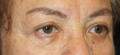 Brow Lift Before & After Patient #21115