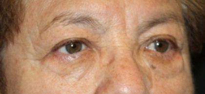 Brow Lift Before & After Patient #21115