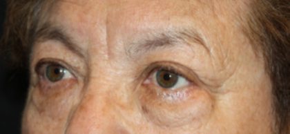 Brow Lift Before & After Patient #21115