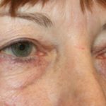 Blepharoplasty Before & After Patient #24988