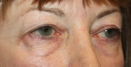 Blepharoplasty Before & After Patient #24988