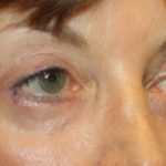 Blepharoplasty Before & After Patient #24988