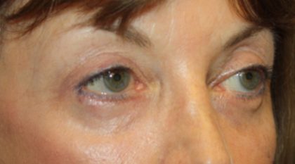 Blepharoplasty Before & After Patient #24988