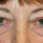 Blepharoplasty Before & After Patient #24988