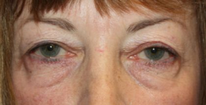 Blepharoplasty Before & After Patient #24988
