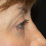 Blepharoplasty Before & After Patient #24988