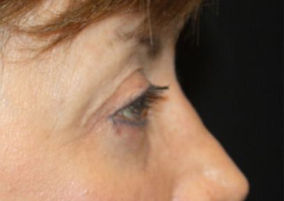 Blepharoplasty Before & After Patient #24988