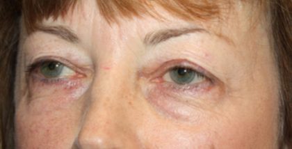 Blepharoplasty Before & After Patient #24988