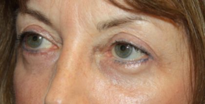 Blepharoplasty Before & After Patient #24988
