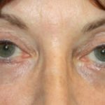 Blepharoplasty Before & After Patient #24988