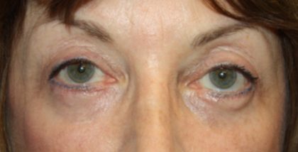 Blepharoplasty Before & After Patient #24988