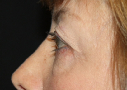 Blepharoplasty Before & After Patient #24988