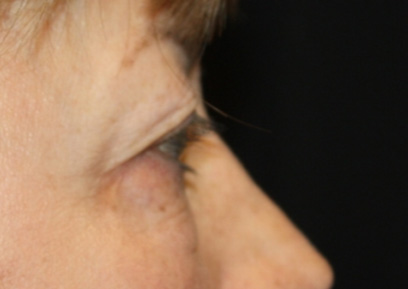 Blepharoplasty Before & After Patient #24988