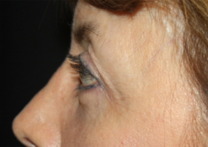 Blepharoplasty Before & After Patient #24988