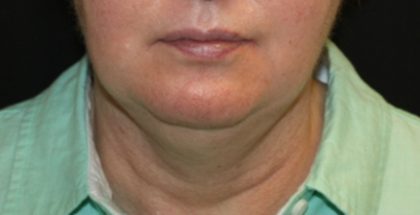 Liposuction Before & After Patient #21404