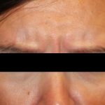 Botox and Dysport Before & After Patient #24748