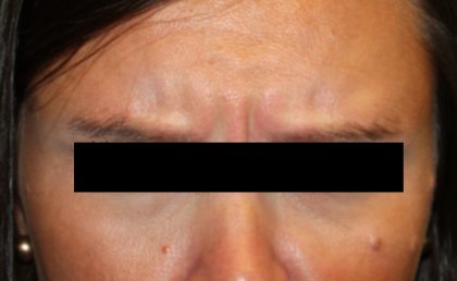 Botox and Dysport Before & After Patient #24748