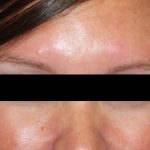 Botox and Dysport Before & After Patient #24748