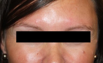 Botox and Dysport Before & After Patient #24748