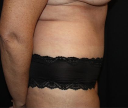 Tummy Tuck Before & After Patient #22992