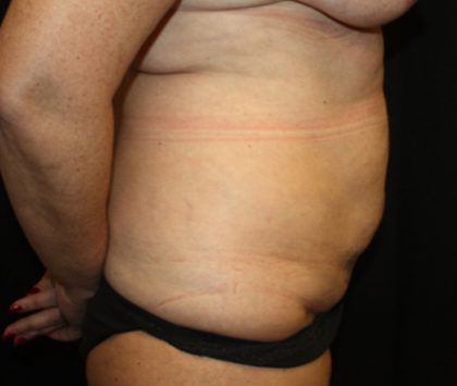 Tummy Tuck Before & After Patient #22992